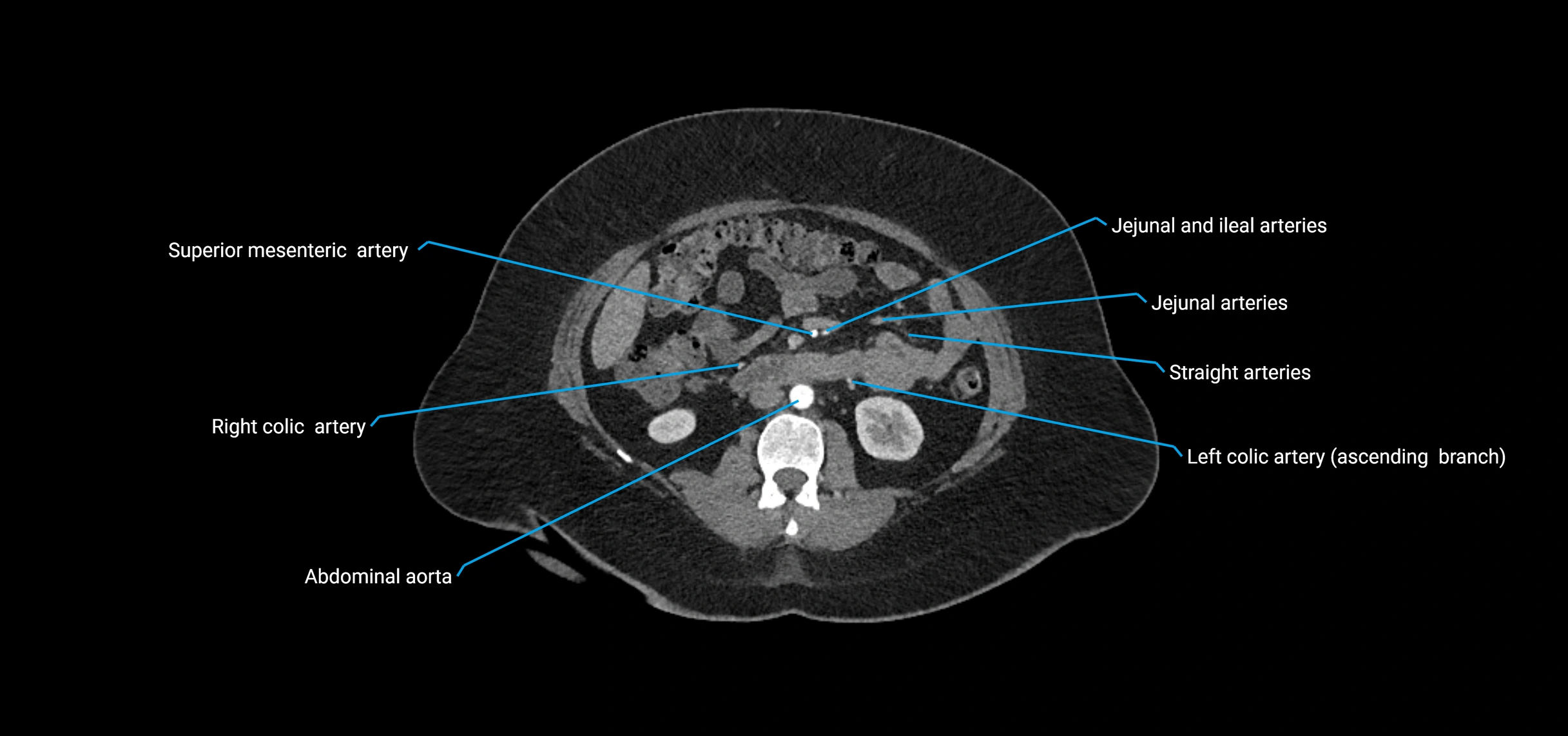 CTA abdomen axial cross sectional anatomy labelled image_92 (2).webp
